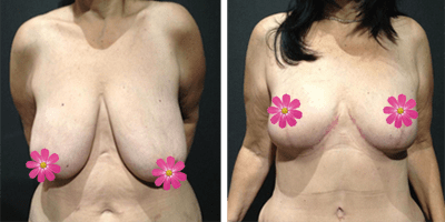 breast reduction dr nick masri