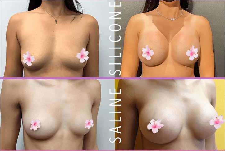 breast surgeries are safe dr nick masri