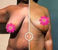 post pregnancy breast lift augmentation