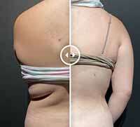 post pregnancy liposuction nidal masri md