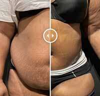 post pregnancy tummy tuck nick masri md