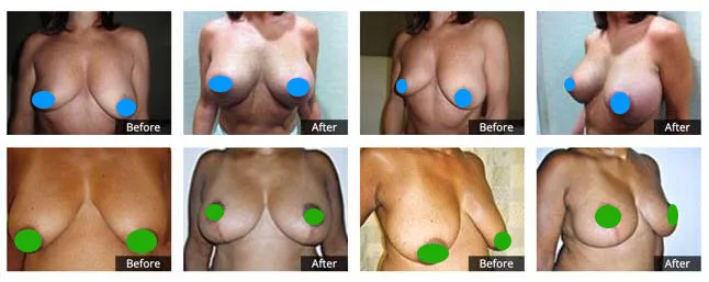 breast lift before and after