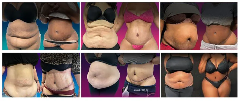 tummy tuck before and after pictures