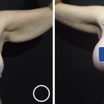 brachioplasty