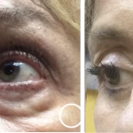blepharoplasty
