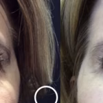 blepharoplasty