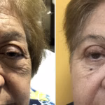 blepharoplasty