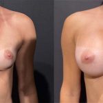 breast augmentation