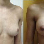 breast augmentation