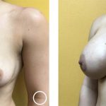 breast augmentation