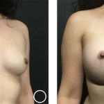 breast augmentation