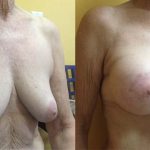 breast lift with implants
