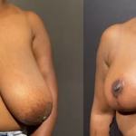 breast reduction