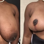 breast reduction