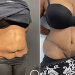 extended tummy tuck