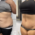 extended tummy tuck