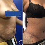 extended tummy tuck