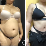 extended tummy tuck