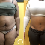 extended tummy tuck