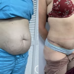 extended tummy tuck