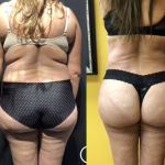 liposuction