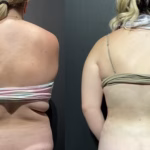 liposuction