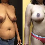 mommy makeover