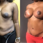 mommy makeover