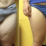 thigh lift