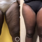 thigh lift
