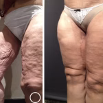 thigh lift