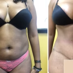 tummy tuck