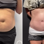 tummy tuck