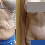 tummy tuck